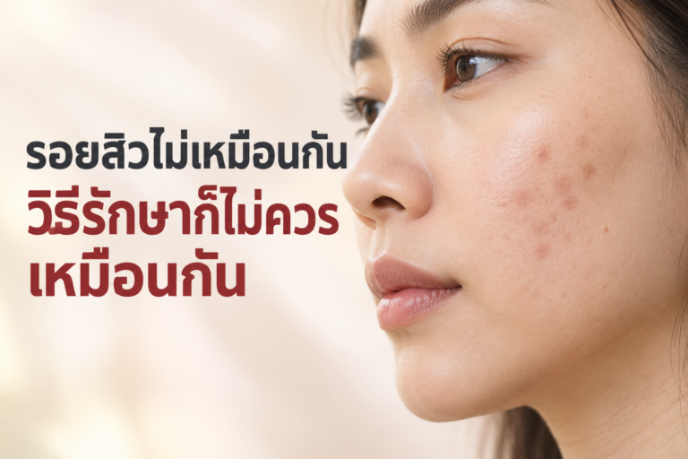 รอยสิวไม่เหมือนกัน วิธีรักษาก็ไม่ควรเหมือนกัน