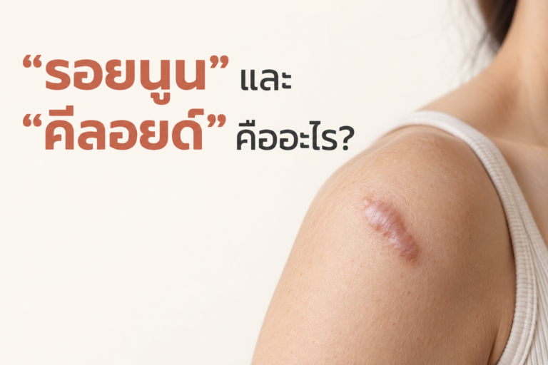 “รอยนูน” และ “คีลอยด์” คืออะไร?