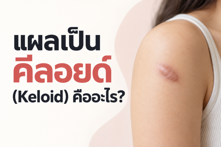 แผลเป็นคีลอยด์ (Keloid) คืออะไร?