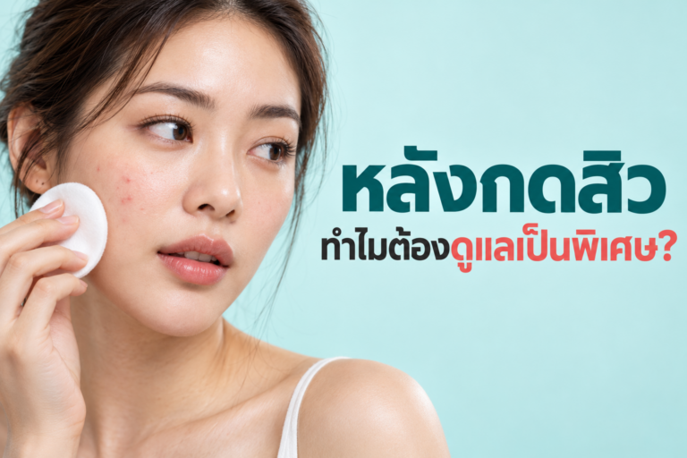 ทำไม “หลังกดสิว” ถึงต้องดูแลเป็นพิเศษ?