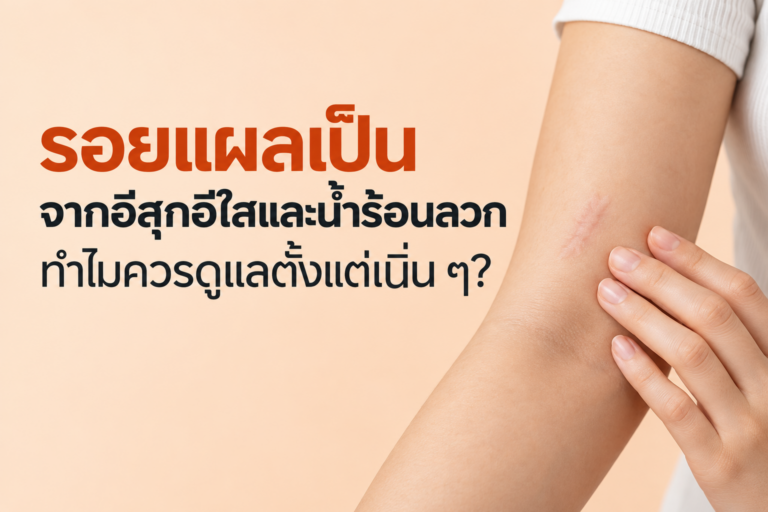 ทำไม “ดูแลตั้งแต่เนิ่นๆ” ถึงสำคัญกับรอยแผลเป็นจากอีสุกอีใสและน้ำร้อนลวก?