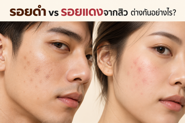 รอยดำและรอยแดงจากสิว ต่างกันอย่างไร?
