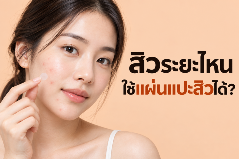 เช็กด่วน! วงจรสิวของคุณอยู่ระยะไหน แล้ว “แปะสิว” ได้หรือยัง?