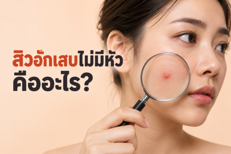 ทำไมต้องเข้าใจ “สิวอักเสบไม่มีหัว” ให้ถูกก่อนแก้